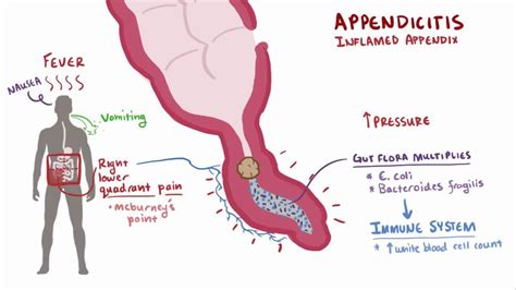 McBurney’s Point: What Is It, Location, and More | Osmosis