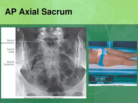 Ligaments Of The Sacrum