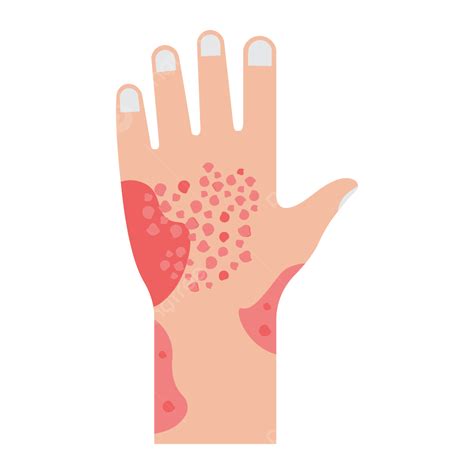 Rash Vector Rash Itchy Hand Png And Vector With Transparent | The Best ...