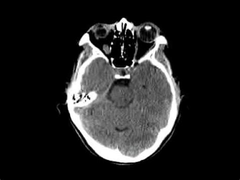 CT scans abnormal brain - YouTube