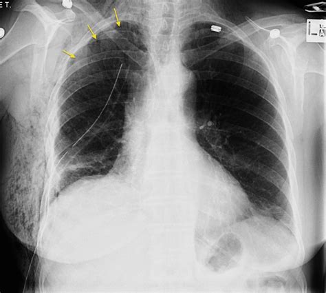 Pneumothorax And Surgical Emphysema Radiology At St Vincent S | My XXX ...