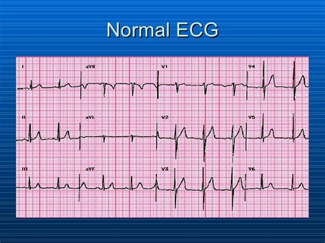 What Is A Normal EKG Look Like