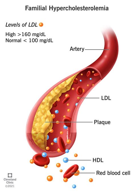 Familial Hypercholesterolemia: Causes and Symptoms