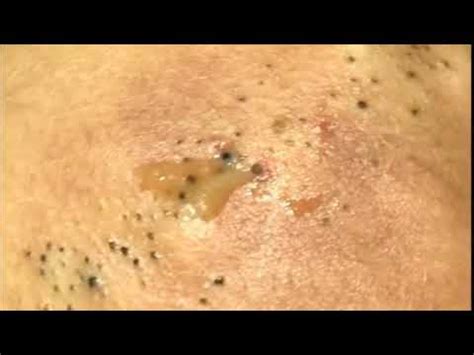 🔴SO SO SO MANY BLACKHEAD REMOVAL ON BACK - YouTube