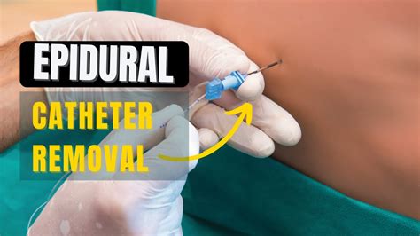 How to Remove Epidural Catheter safely - YouTube