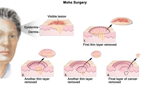 Mohs Micrographic Surgery - Skin Cancer, Advantages, Complications