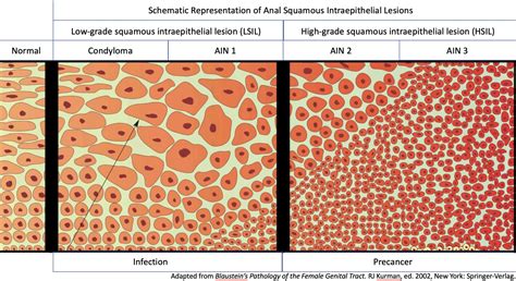 Anal Pre-Cancer: Squamous Intraepithelial Lesions | Anal Neoplasia Clinic, Research and ...