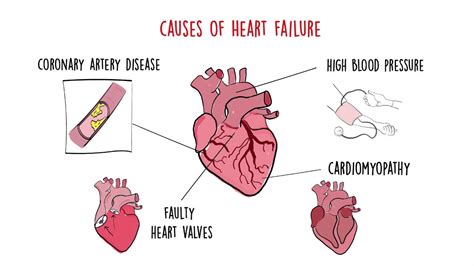 World Heart Federation Roadmap on Heart Failure - YouTube