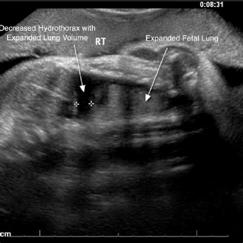 Follow-up fetal ultrasound at 32 weeks. Hydrops fetalis has resolved... | Download Scientific ...