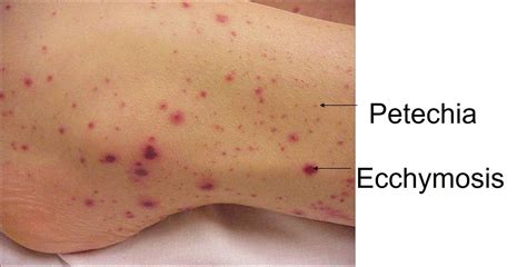 Ecchymosis Vs Petechiae