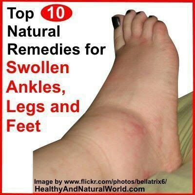 In Case You Missed: The Top 10 Natural Remedies for Swollen Ankles ...