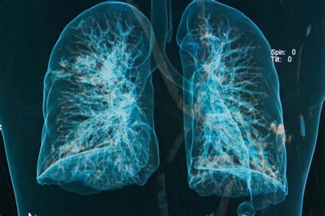 Silicosis – a new epidemic of an old occupational lung disease?