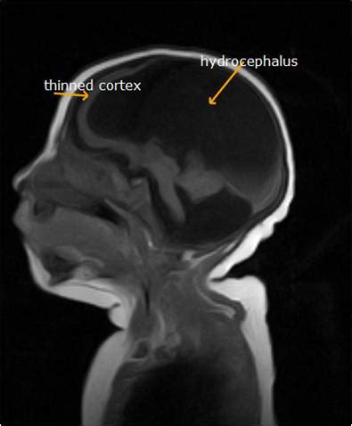 Dandy Walker Malformation-MRI - Sumer's Radiology Blog