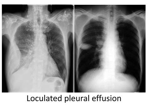 PPT - Pleural Effusion Clinical symptoms and sign - Dr. Sheetu Singh ...