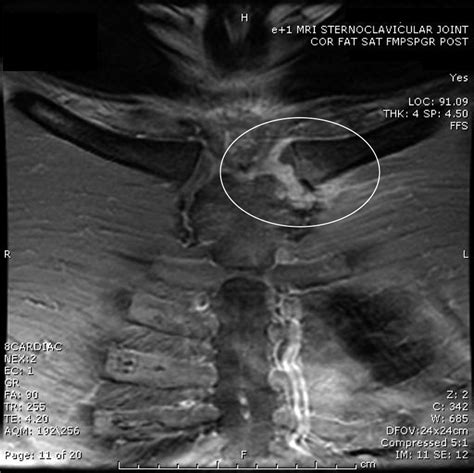 Sternoclavicular Joint Arthritis