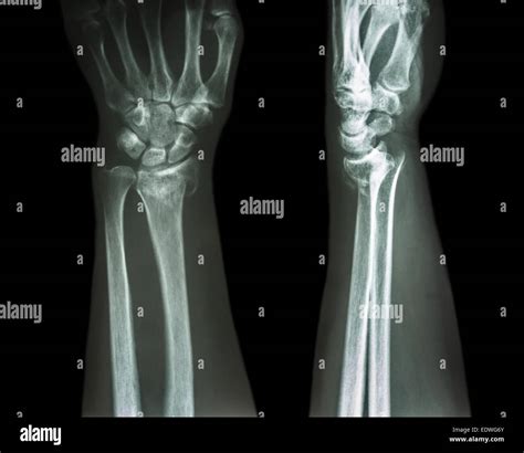 Left Colles Fracture