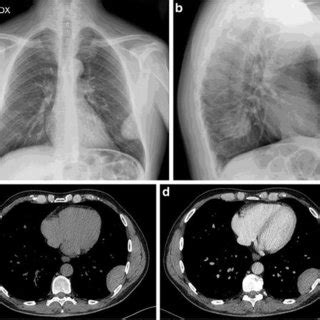 Biphasic mesothelioma; chest X-ray film (a) showing a right basal and ...