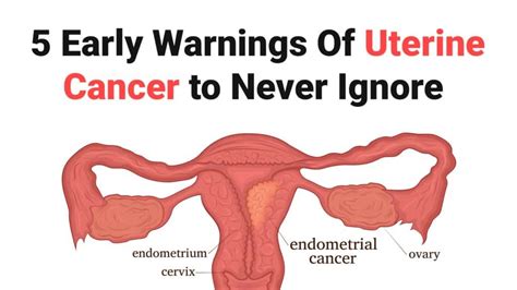 5 Early Warnings Of Uterine Cancer to Never Ignore