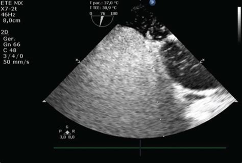 Transesophageal echocardiogram. Image revealing patent foramen ovale ...