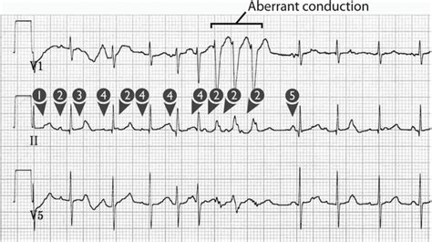 Multifocal Atrial Tachycardia | Thoracic Key