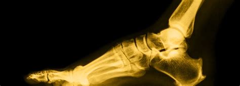 How to Prepare for Ankle Replacement Surgery - New Mexico Orthopaedic ...