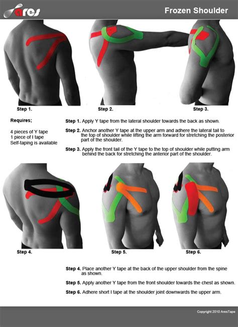 Frozen Shoulder - Ares • TheraTape Education Center | Frozen shoulder, Kinesiology taping ...