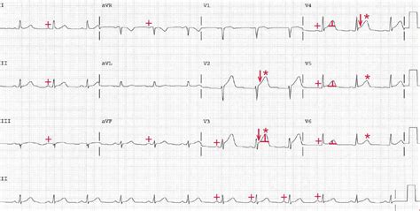 ECG Case 134: Acute Anterior MI - Manual of Medicine