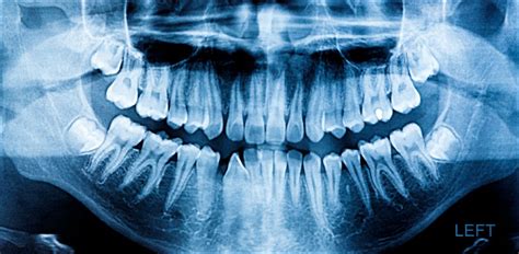 Oral & Dental X-Rays, Xrays Of Teeth Burlington | Britannia Dental Centre