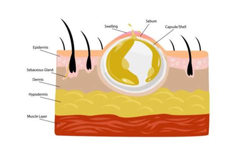 Cyst Removal Singapore | Treatment by a Dermatologist