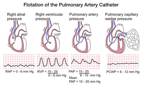 PA catheter, Pressures Cath Lab Nursing, Nursing Tips, Nursing Study, Nursing Notes, Nursing ...