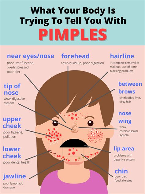 Acne Chart, Back Pimples, Pimples On Face, Pimple Causes, Acne Causes ...