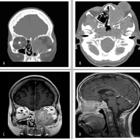 Preoperative clinical examination. A. Left exophthalmia, prominence and... | Download Scientific ...