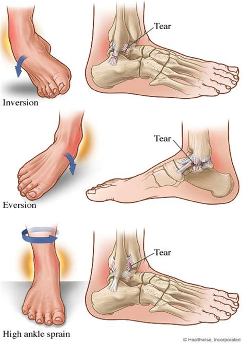 Ankle Injuries in Tennis | Ponsonby Physiotherapy