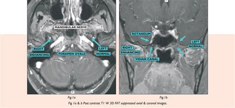 Glossopharyngeal Nerve Mri