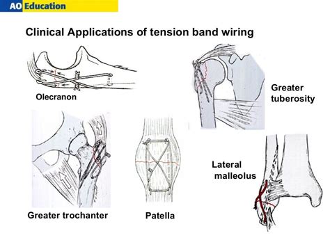 tension band wiring