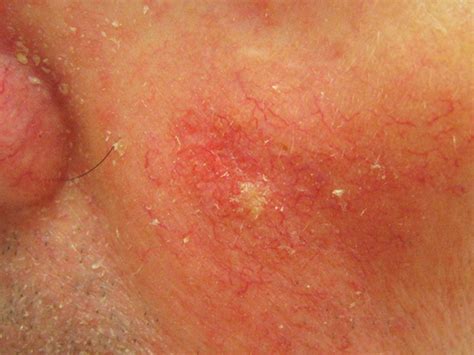 Actinic Keratosis - Pictures, Causes and Treatment