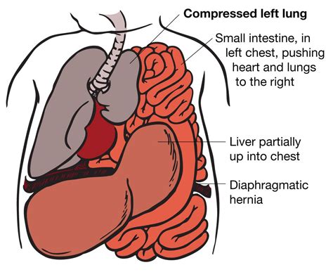 Illustration of CDH with lung compression | Medical ultrasound, Medicine studies, Anatomy and ...