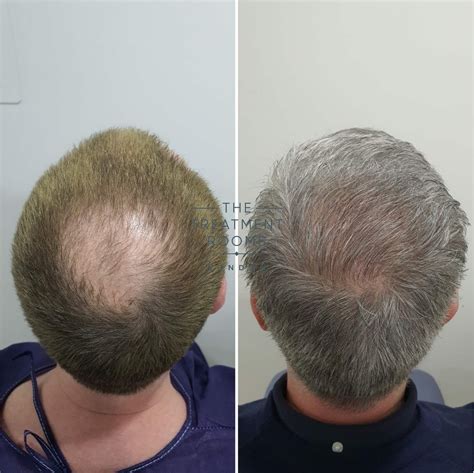 Balding Crown & Crown Hair Transplant | Treatment Rooms London