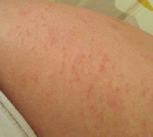 Itchy Bumps on Arms - Pictures, Symptoms, Causes, Treatment