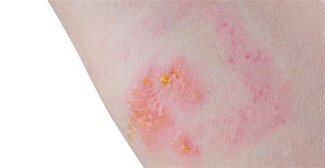 How To Get Rid Of Poison Ivy Rash On Skin