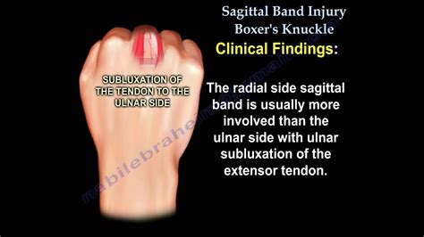 Sagittal Band Injury Boxer's Knuckle - Everything You Need To Know - Dr. Nabil Ebraheim - YouTube