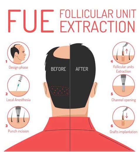 FUE Hair Transplant Los Angeles | Cost in Nuance Plastic Surgery