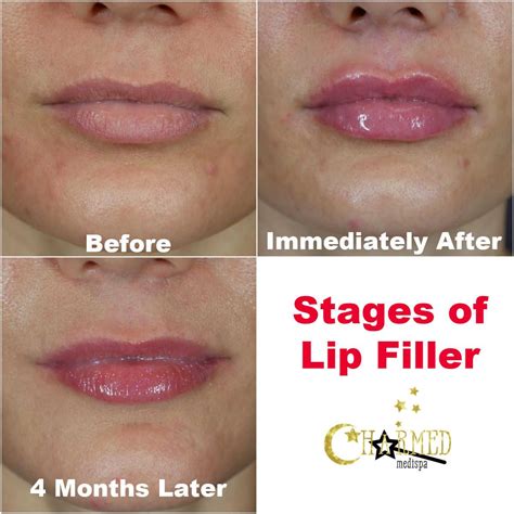 Stages Of Lip Injections And What To Expect At Charmed Medispa ...