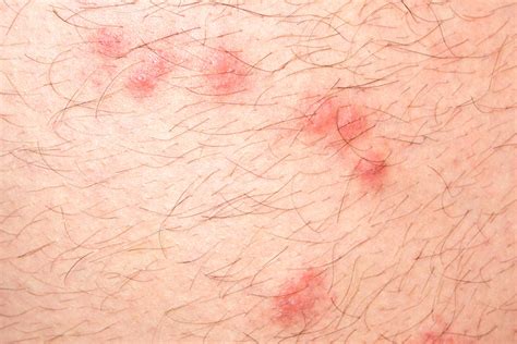 Identifying Bug Bites: How to Figure Out What Bit You | Best Health Canada
