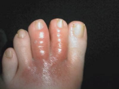 Swollen Red Toes