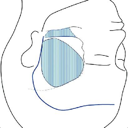 e schema demonstrating the range of the pterional craniotomy and ...