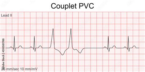 Electrocardiogram Show Premature Ventricular Contract - vrogue.co