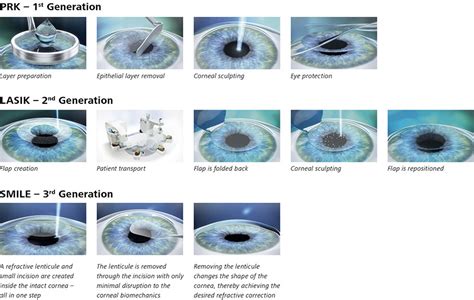 Laser Eye Surgery - Googles 21 Most Popular Questions