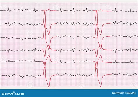 Tape ECG with Ventricular Premature Beats (quadrigemini) Stock Image - Image of ventricular ...