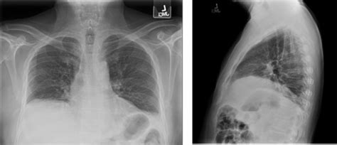 Hemidiaphragm With Bibasilar Atelectasis. Posteroanterior and lateral... | Download Scientific ...